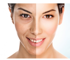 Microdermabrasion In Leeds